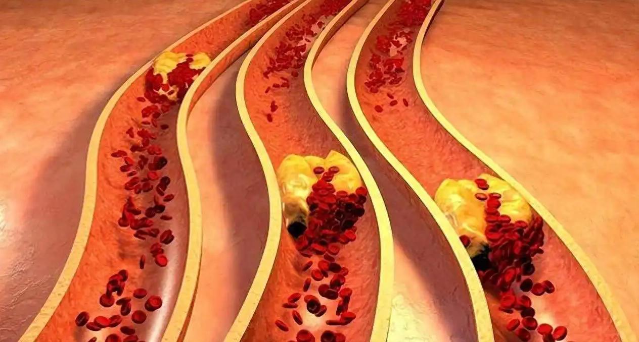 重度血瘀别瞎活血！记住顺序：泻火→活血→化瘀→补气血，才是根治之道提示：本内容