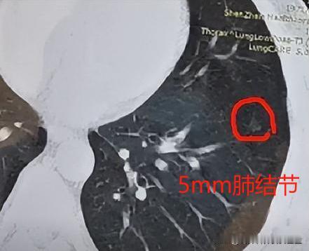 发现5mm肺磨玻璃结节，多久复查才安全？回原医院、原机器上检查更准确？很多朋友体