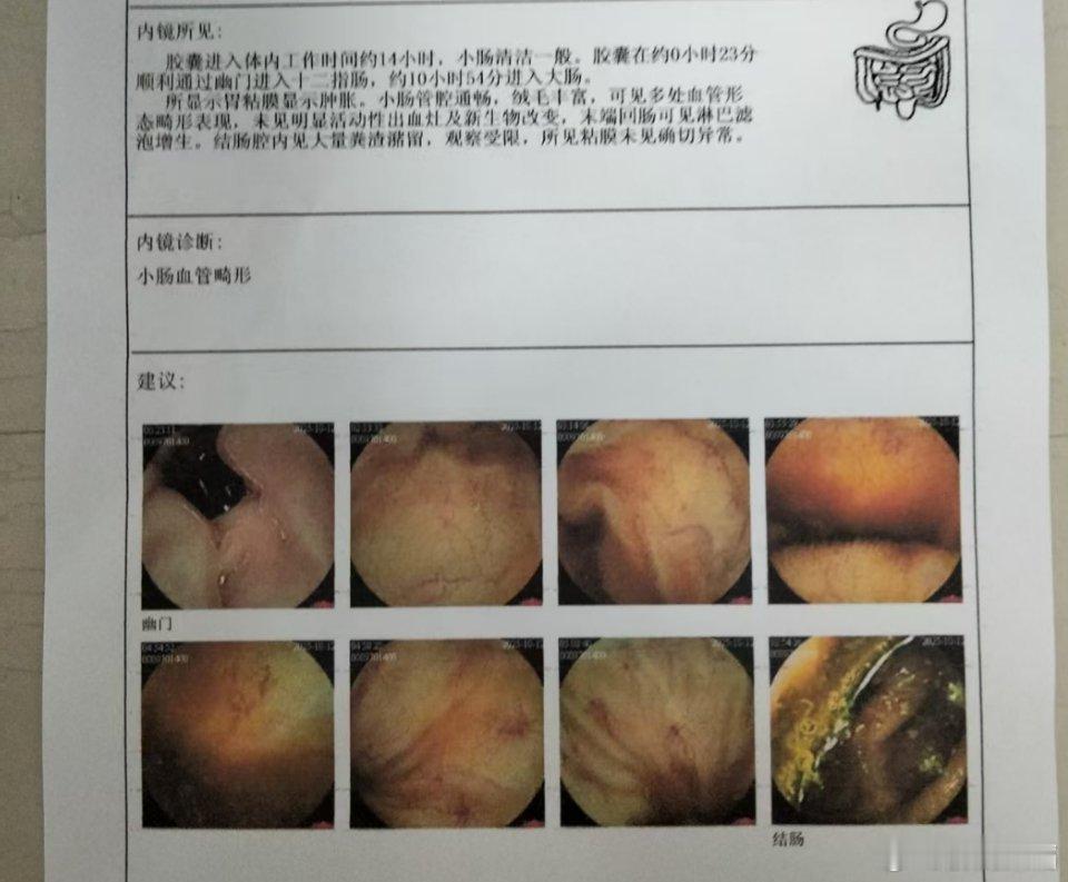 胶囊内镜主要用于检查小肠病变，而对于胃，大肠，最好还是选用胃肠镜，对病变的检查更