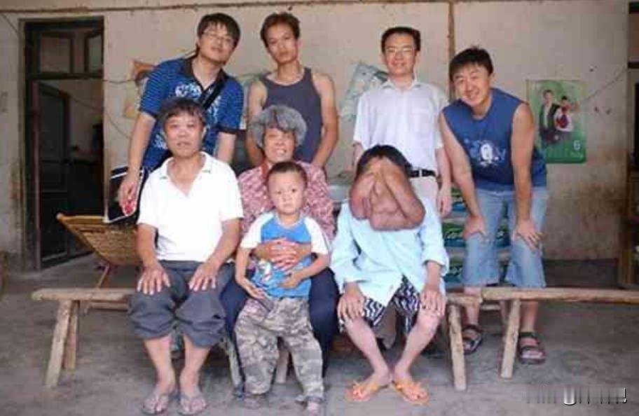 2006年，湖南郴州男子脸长大肉球，重达四十斤垂至腰间，每走一步都要双手托举，因