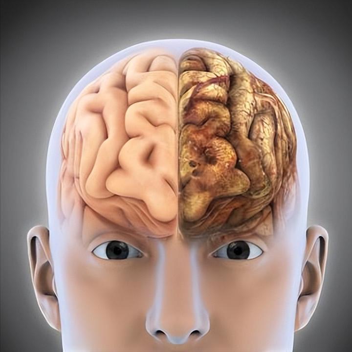 脑梗抢救成功≠脱险！四大隐藏杀手要知道 1.脑水肿脑梗死后，患者受损的脑