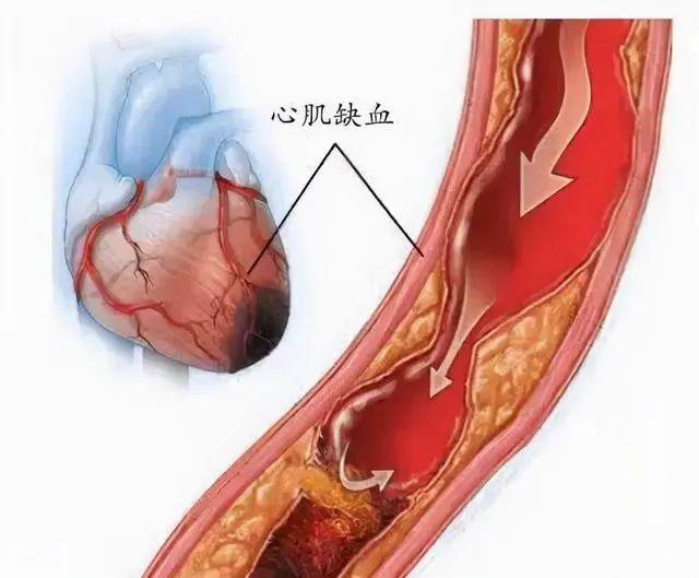身体5个表现，可能是心肌缺血了！两味中药煮水喝，恢复心脏供血心肌缺血常发生在