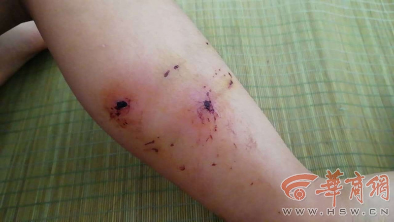 渭南市一儿童被狗咬伤 鉴定后属于犬咬伤Ⅲ级