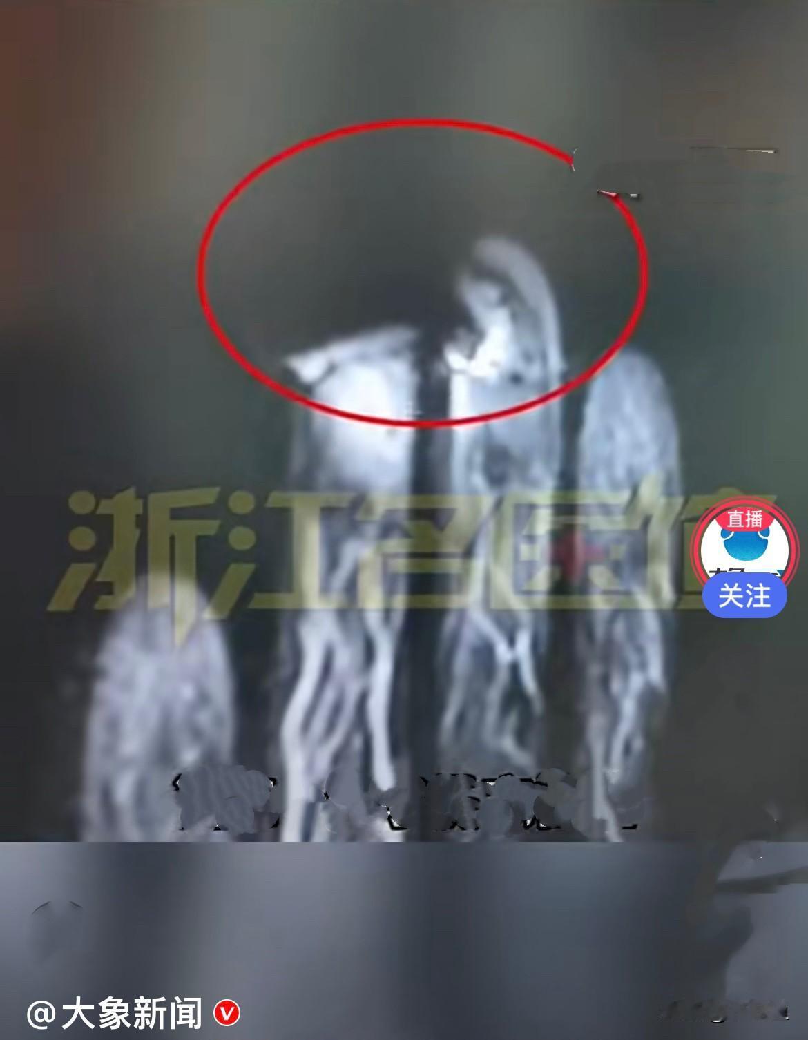 近日，浙江一位女生骑车不小心弄伤了手指，一直隐隱作痛，于是去医院做核磁共振检查，