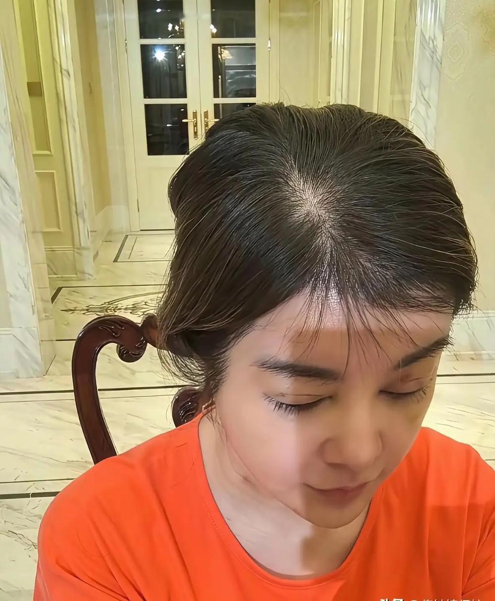 于文红一天天的这里打针那里换雪的，看这头皮，也不年轻了啊！白头发，也不染一染，身