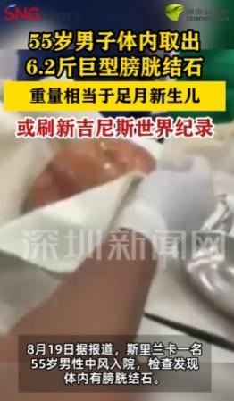 万万没想到！斯里兰卡东部，有一位55岁男子从体内取出6.2斤巨型膀胱结石，这重量