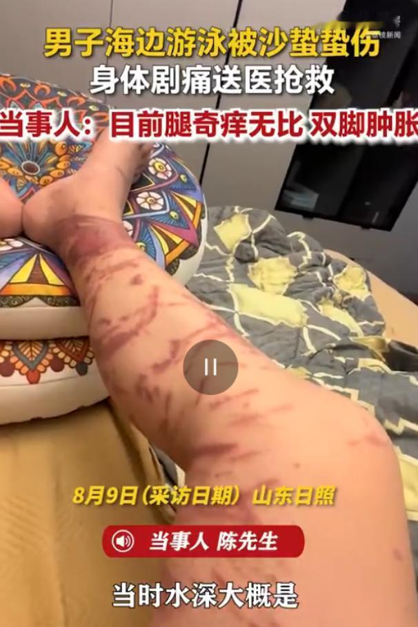 山东日照，男子下海游泳，万万没想到到在浅水区突然遭遇了水下“隐形杀手”，当场像触
