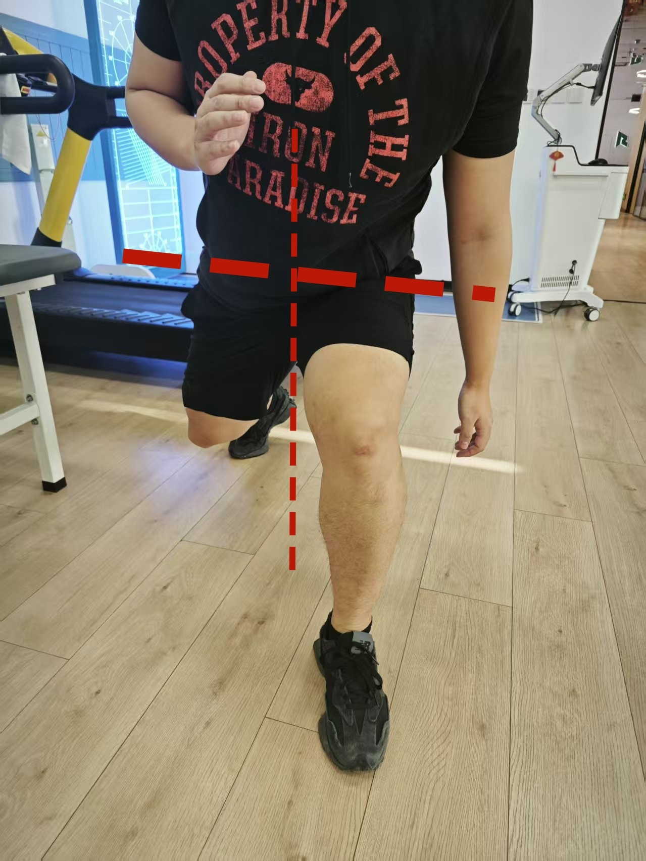 髌骨软化髌骨软化膝盖疼只练肌肉力量？no！在北京奥森门诊的患者，其实就是一名体
