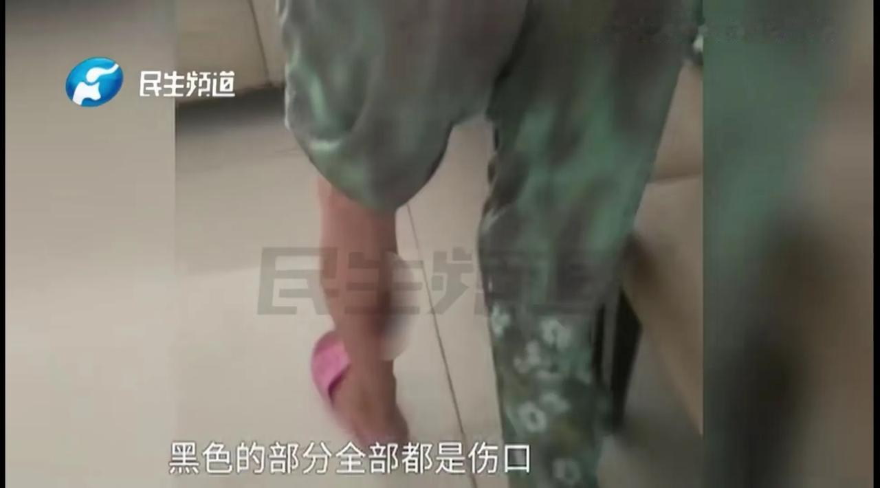 “这位大妈真可怜，小便宜不能贪啊”！河南郑州，大妈去养生馆做免费艾灸，谁料次日却