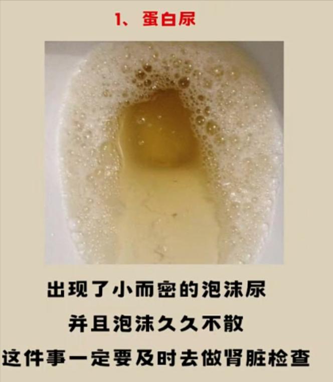 出现这四种表现，警惕糖尿病肾病找上门