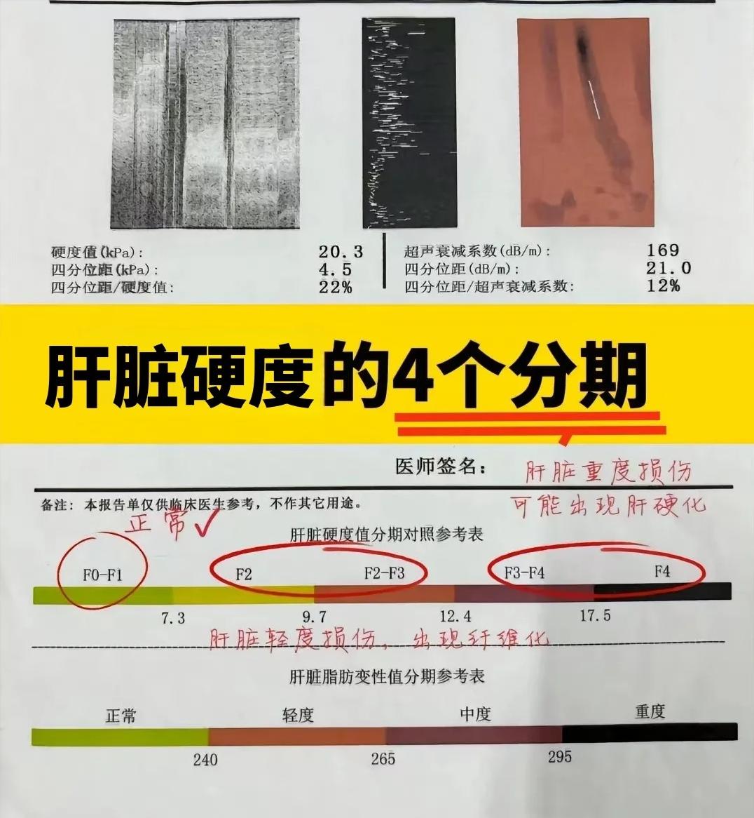 肝脏硬度7.3kPa警戒线：自测肝脏纤维化/肝硬化风险！当肝脏发生炎症时，我们