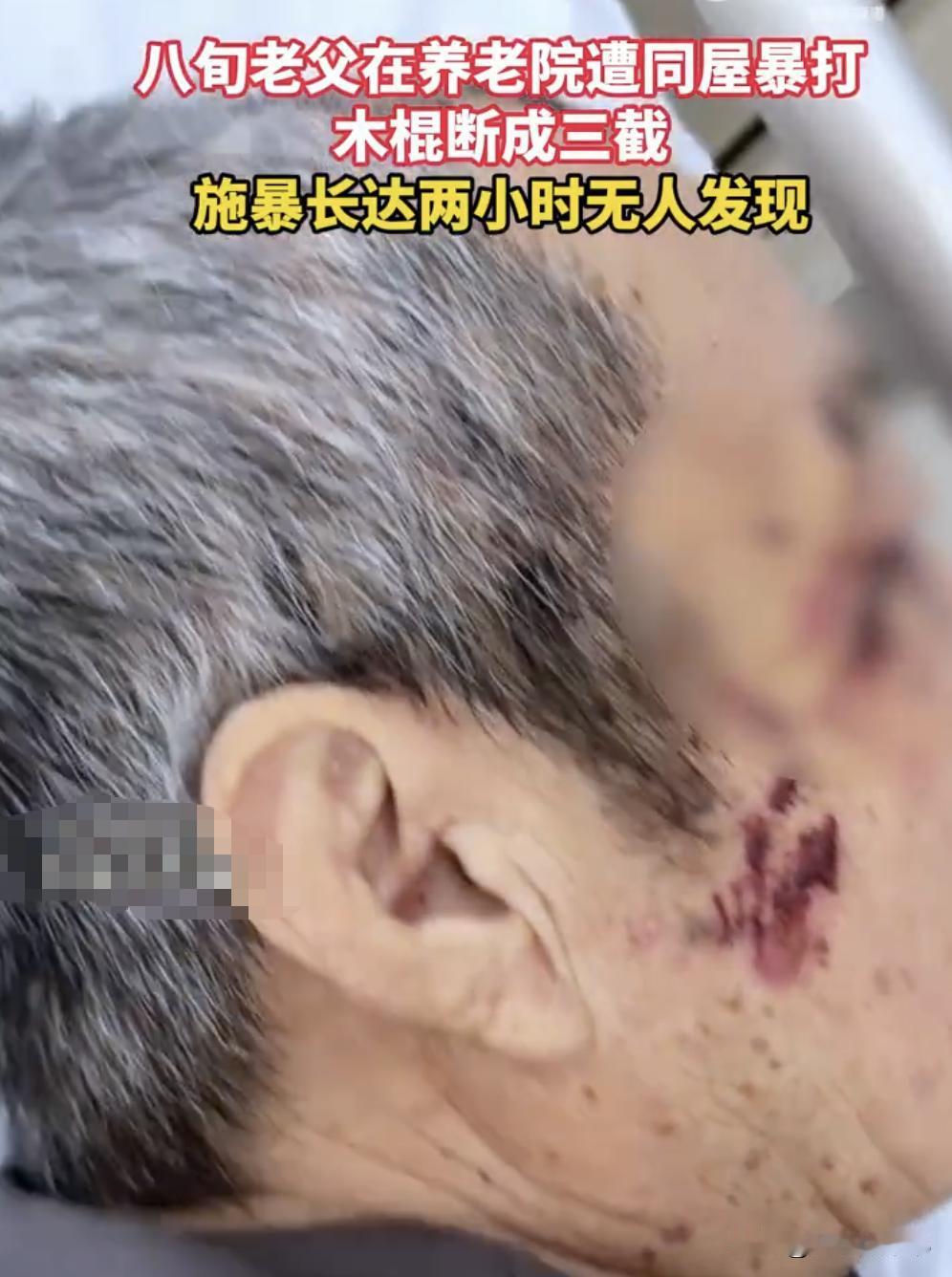 离大谱！73岁的老人在养老院，被85岁的室友打到大小便失禁。我能想到住养