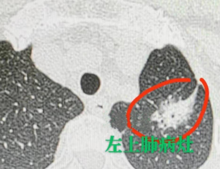 在门诊接诊了一个让人特别揪心的病例，全程看下来心里格外沉重。患者女儿全程坐在诊室