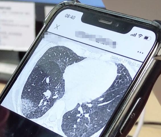 最近线上接诊时遇到一位患者，看了她的CT片，总觉得有些“不太对劲”。后来她来门诊