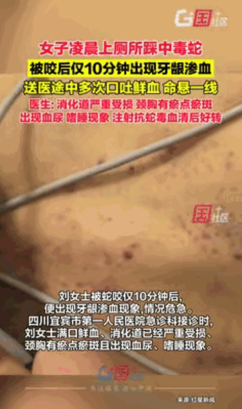 不幸中的万幸！”6月20日，云南，60岁女子凌晨上厕所踩中毒蛇，仅10分钟后出现