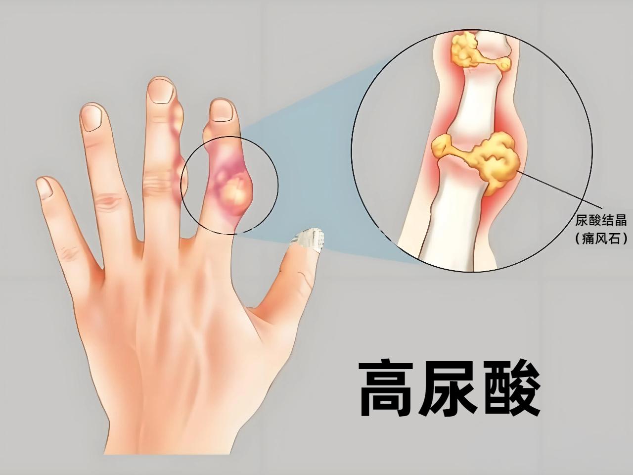 尿酸高患者科学饮食指南高尿酸血症是嘌呤代谢紊乱引发的慢性代谢性疾病，如今国内患