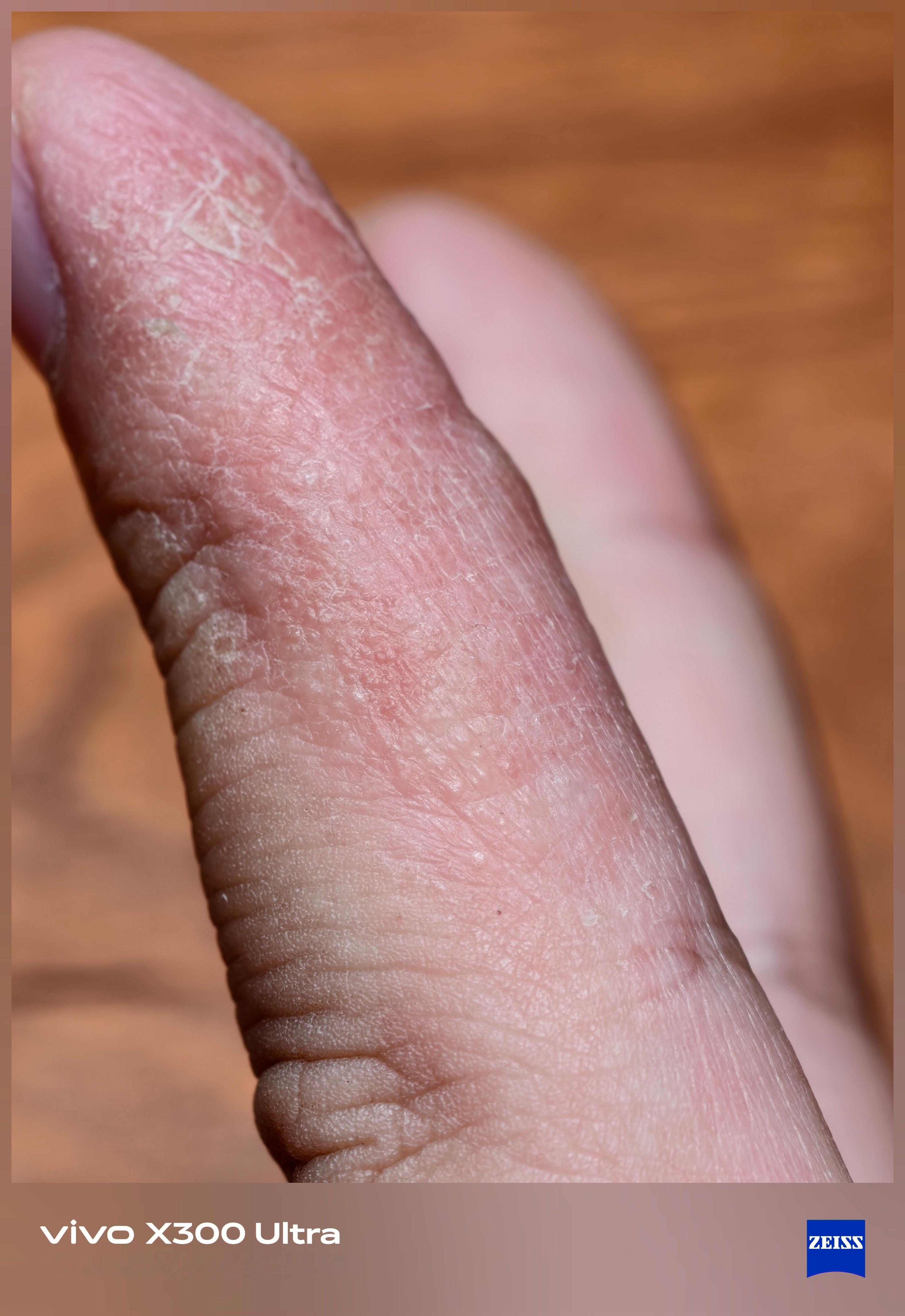 X300Ultra的微距也还是非常可以的…我手上的汗疱疹已经好几年了，每到换