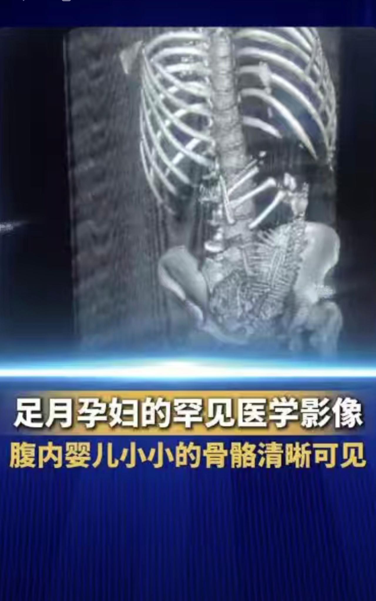 医生分享足月孕妇罕见医学影像：患者在不知道自己怀孕的情况下进行了医学影像检查，
