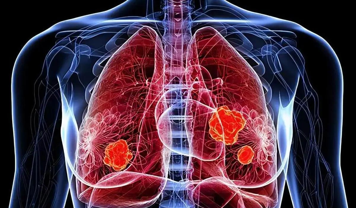 61岁老人体检现肺部2.5厘米阴影，家人急切安排手术切除，却在病理报告中发现已是