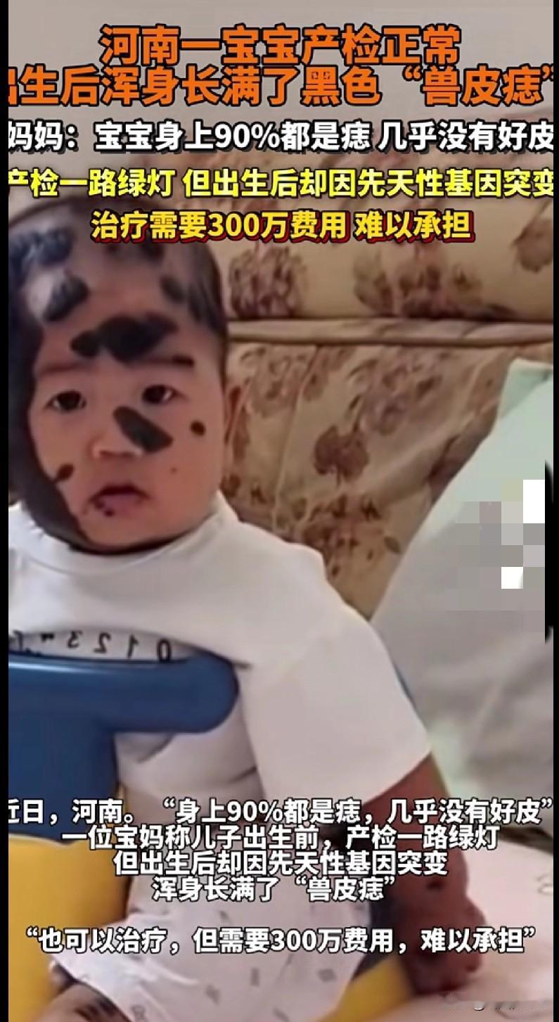 产检全绿灯的宝宝，生下来满身“兽皮痣”：300万治疗费压垮了爸妈这宝宝的样