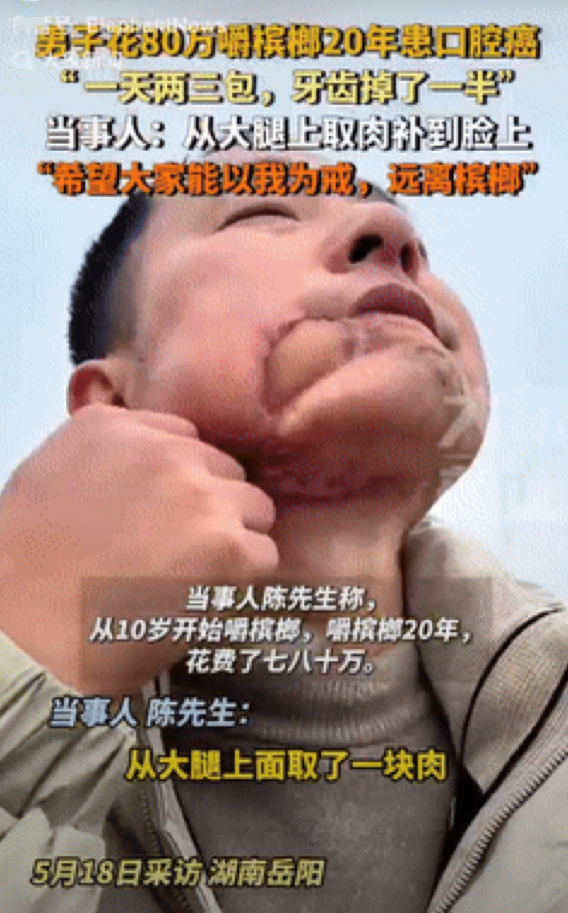惨痛的教训！湖南，男子从10岁开始嚼槟榔，一连嚼了20年，一天要吃2,3包，花费
