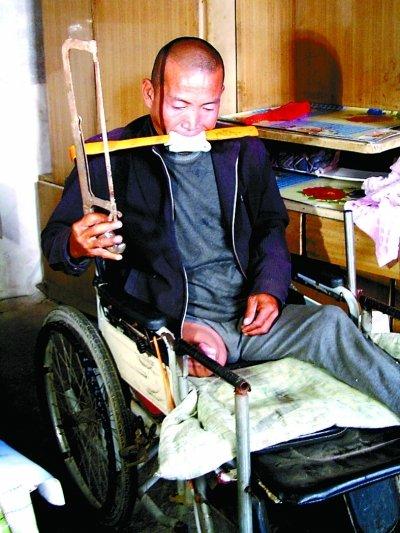 钢锯下的生命强者：郑艳良的重生之路2012年，河北农民郑艳良因双腿动脉栓塞