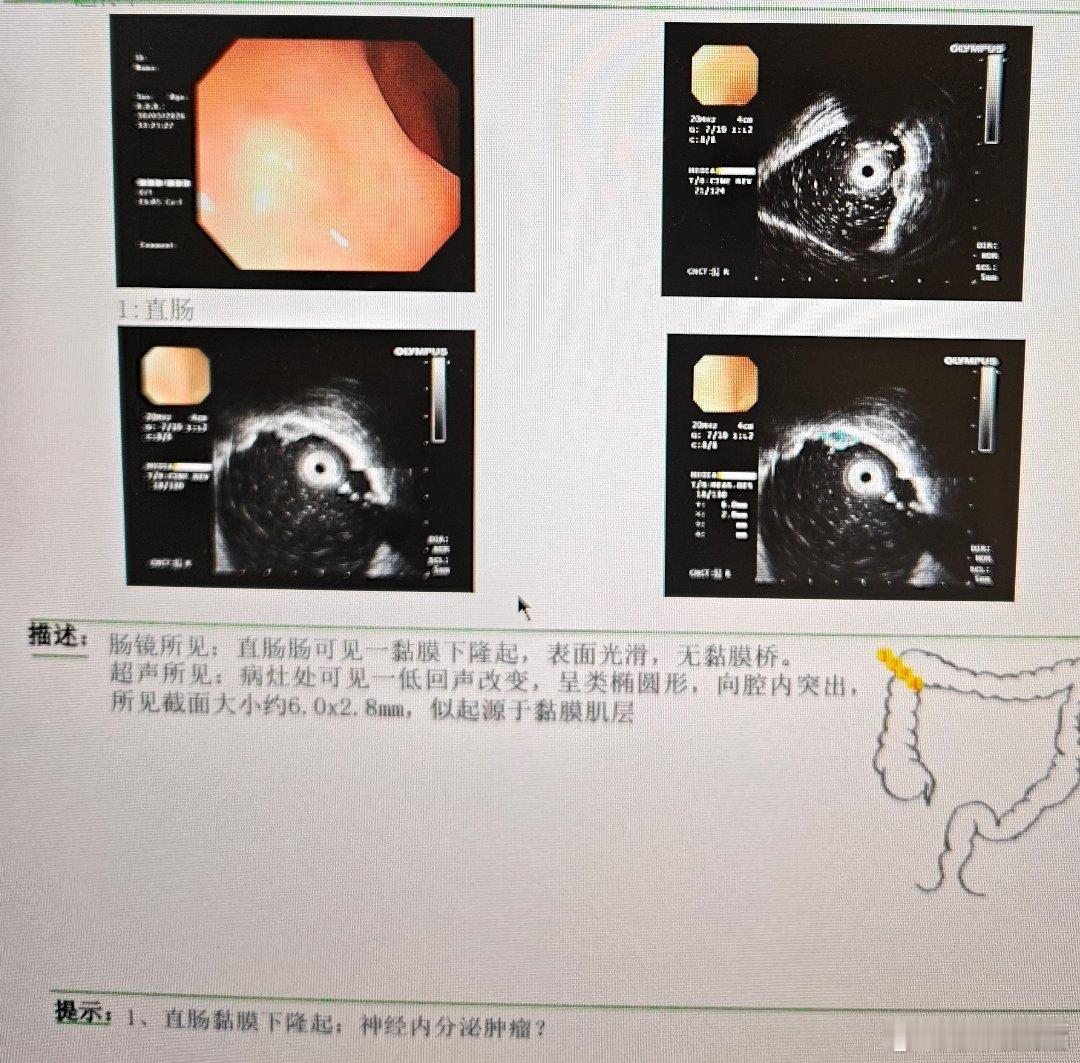 直肠壁在EUS下呈5层结构（高低回声相间），从内到外依次为：1. 第1