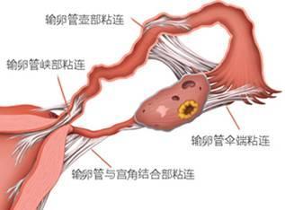 输卵管粘连会给女性朋友带来哪些危害