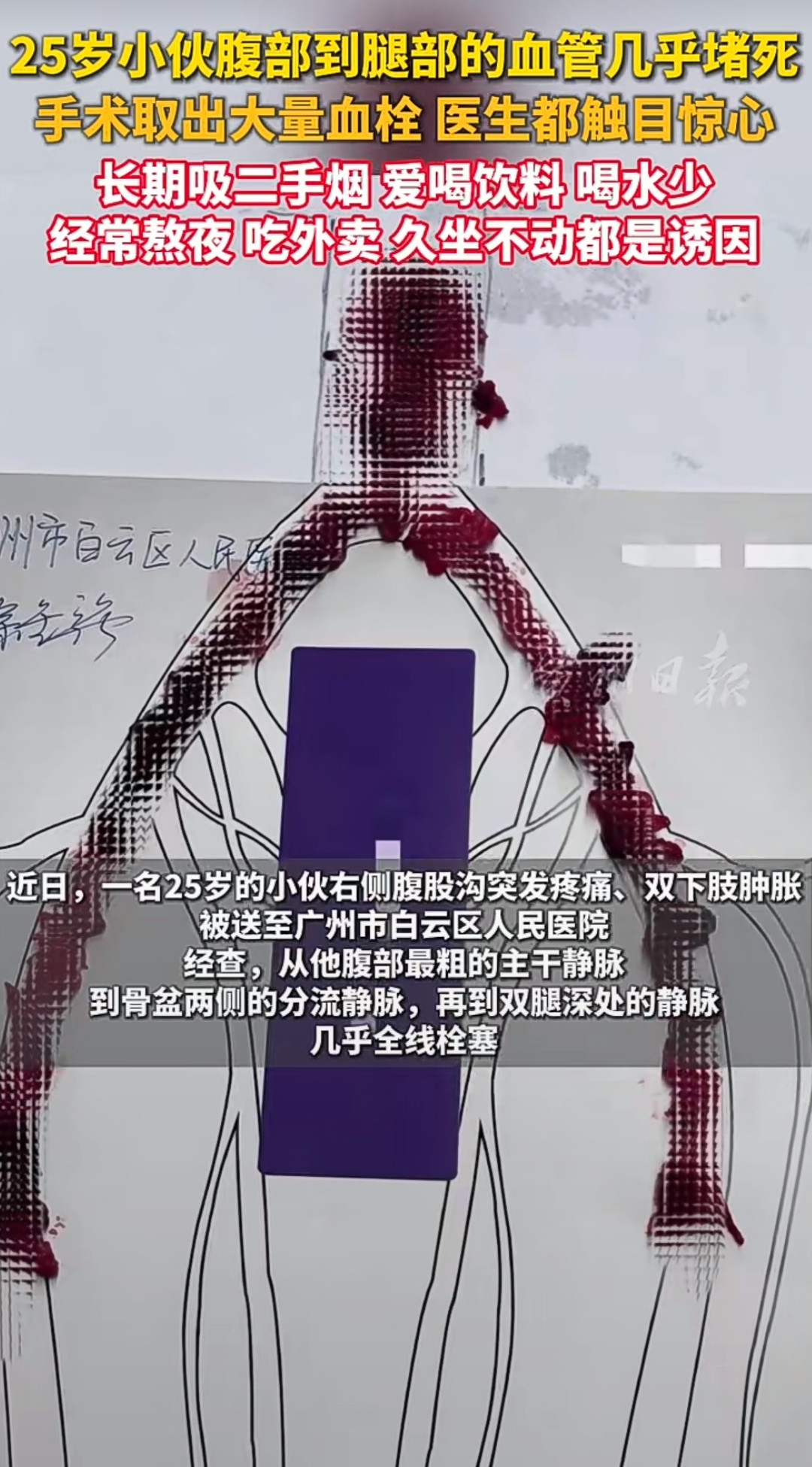25岁的小伙子，腿上连到肚子里的大血管几乎全堵死了，医生做手术掏出来一大堆血栓，连见多识广的大夫看了