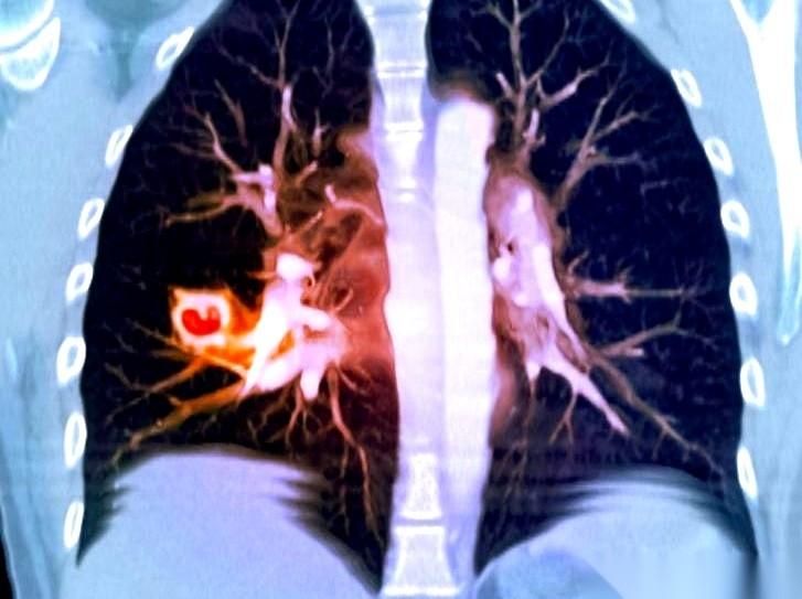 体检报告上那个叫“结节”的小东西，说白了，就是一团垃圾。一口老痰，夹着点死血，