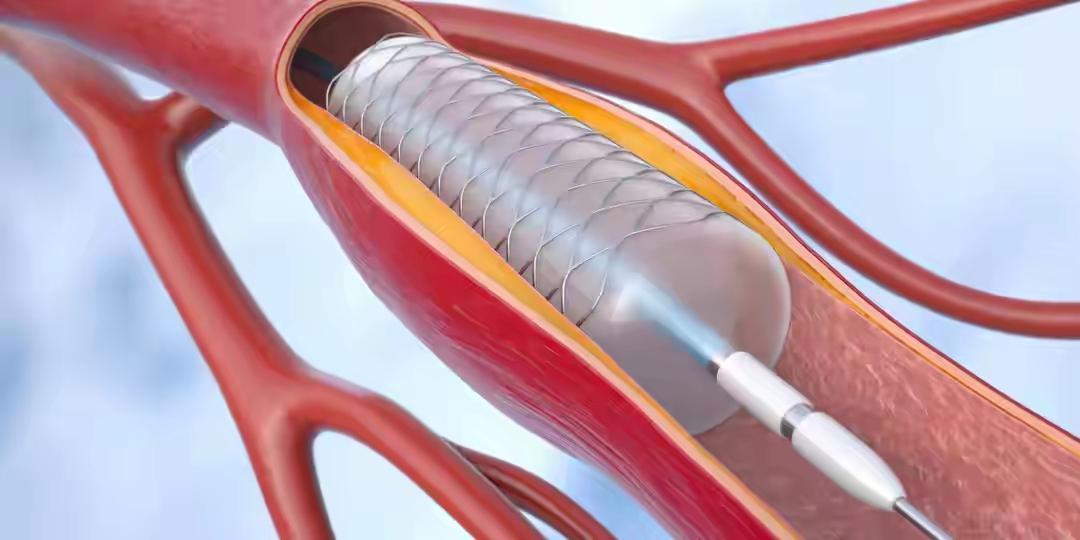 ❤️心梗后坚决不放支架会怎样？医生实话实说：2种结局，没有中间路——这不是“