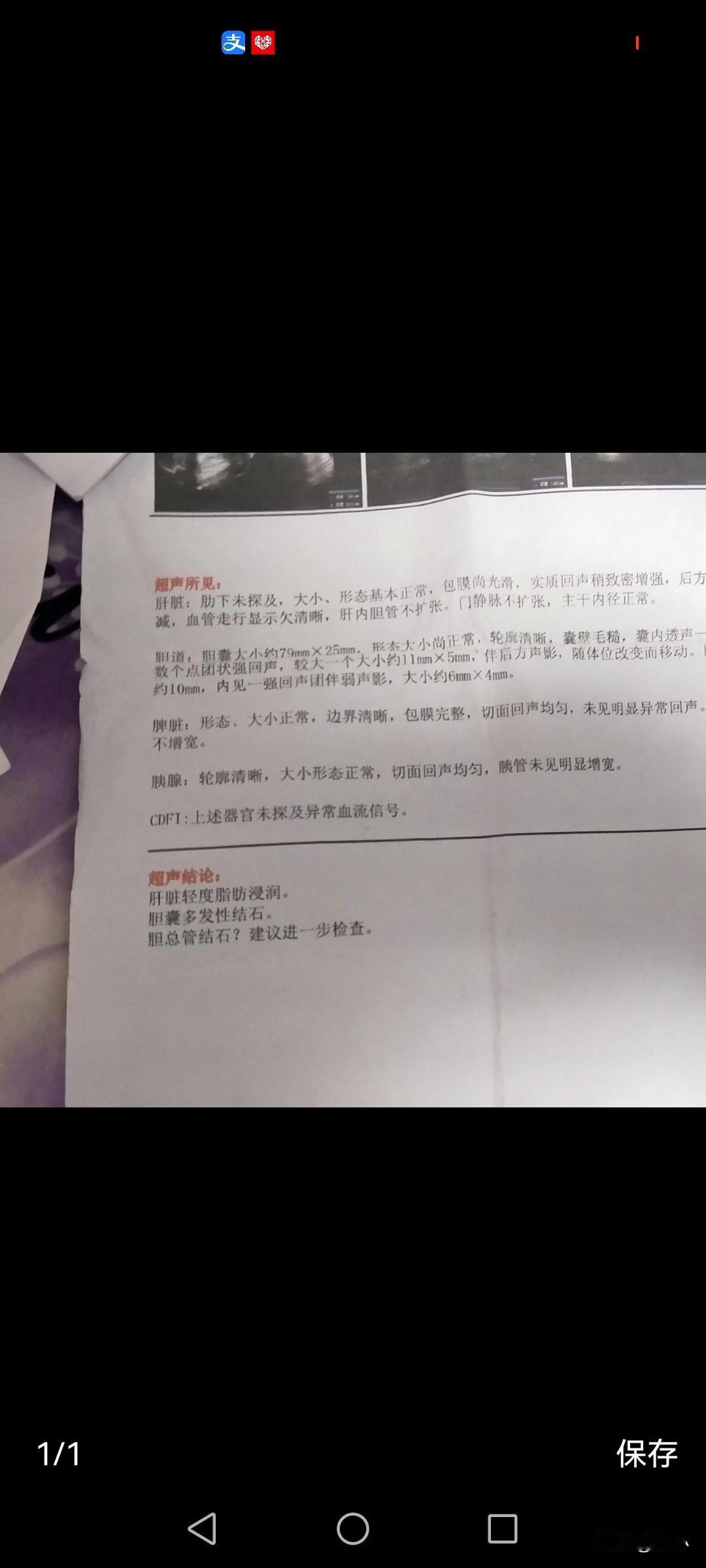 很多人都说胆结石排不出来，我也相信排不出来，胆管太小，石头比小，怎么排？胆