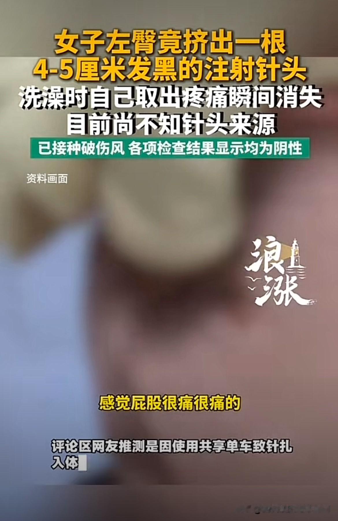 浙江，女子左侧臀部疼了一个多月，她还以为是平时锻炼肌肉拉伤，并未放在心上。岂料一