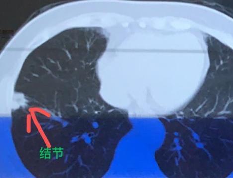 从医30多年，我遇到过不少因为不愿手术，而耽误病情的患者。今天想分享一位59岁女