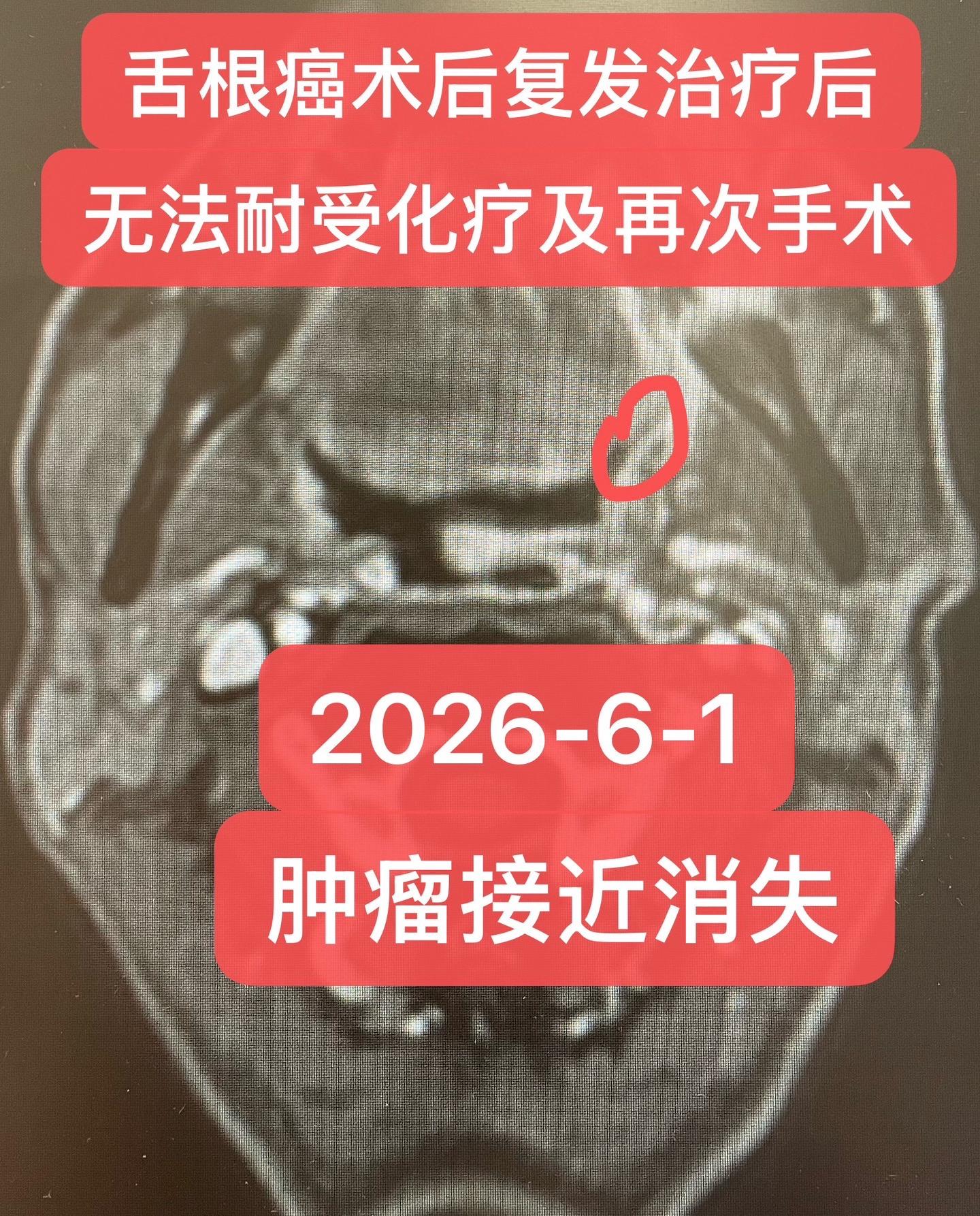 舌癌术后复发的挽救治疗。63岁，男性，2024年舌根鳞癌术后行2次化疗...