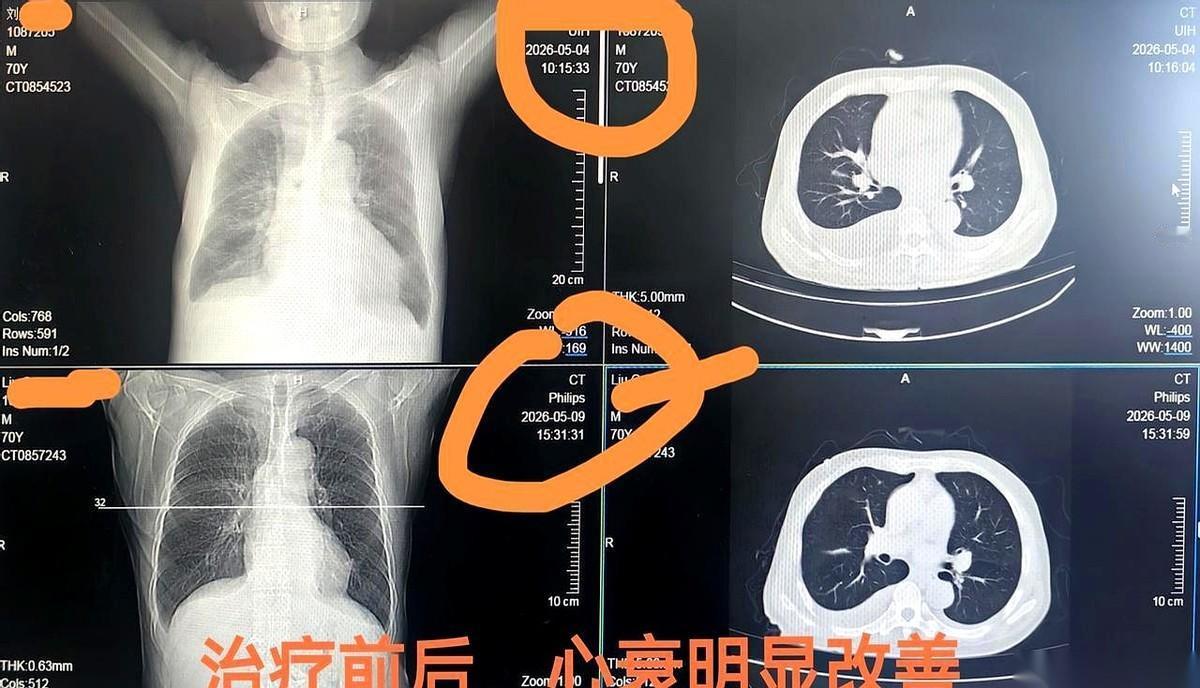 一个70岁的老爷子，自己走进医院，就为了治个疝气。结果一张检查报告拍在桌上，家