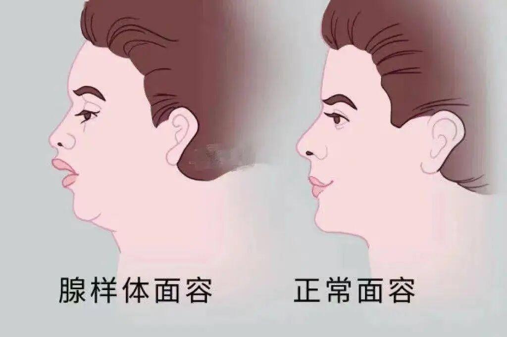 孩子打鼾张口、腺样体不消？普通药通不到的病根，全靠这味药深挖坐门诊，几乎每天都