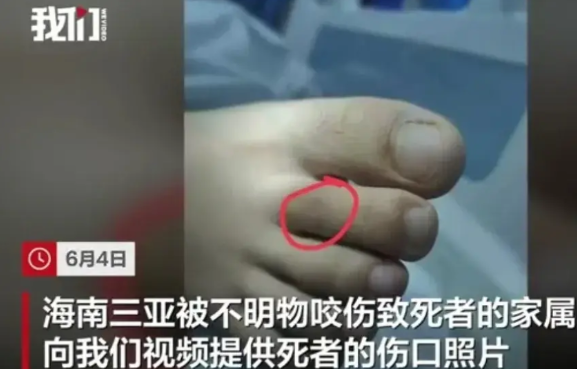 这条命，本可以不用丢的。三亚被咬女孩的伤口照片公布了，就脚趾头上两个小针眼似
