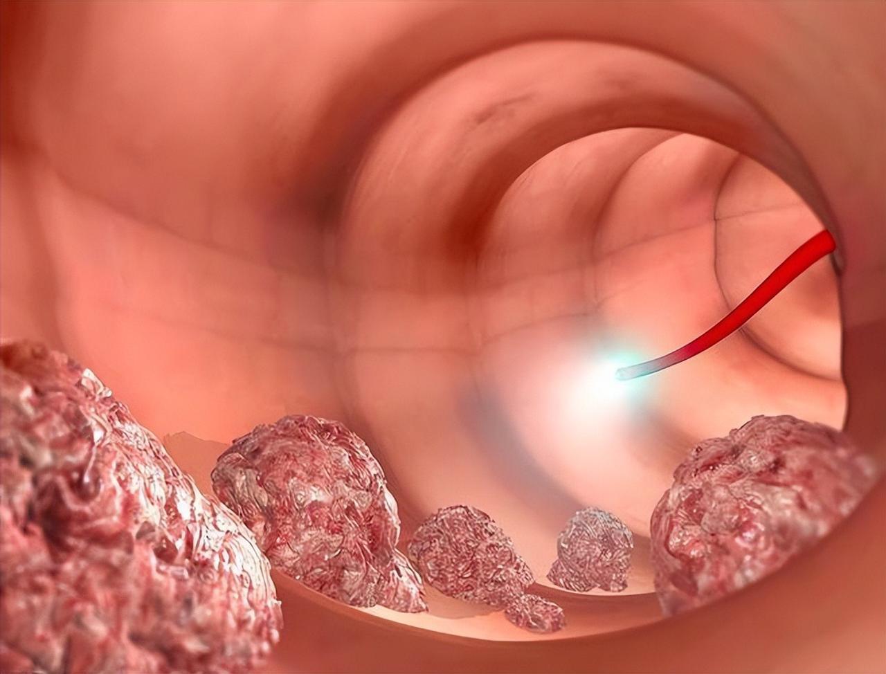 最新研究：黄连素可预防肠息肉；停药6年后，复发风险仍降低42%！肠息肉不是新