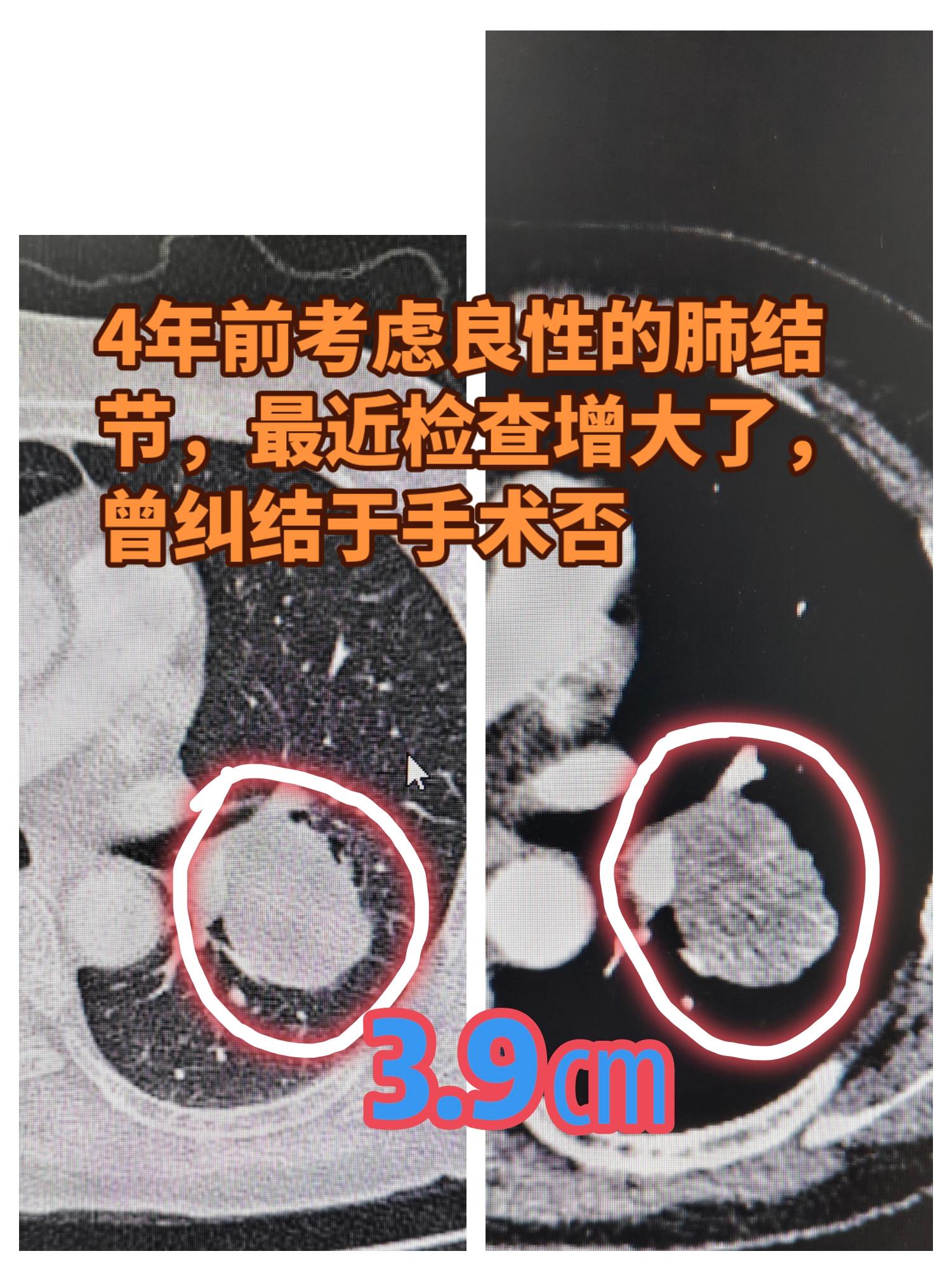 增大的肺结节，是要重视的！不是说肺结节考虑良性就不管不问，高枕无忧了。...