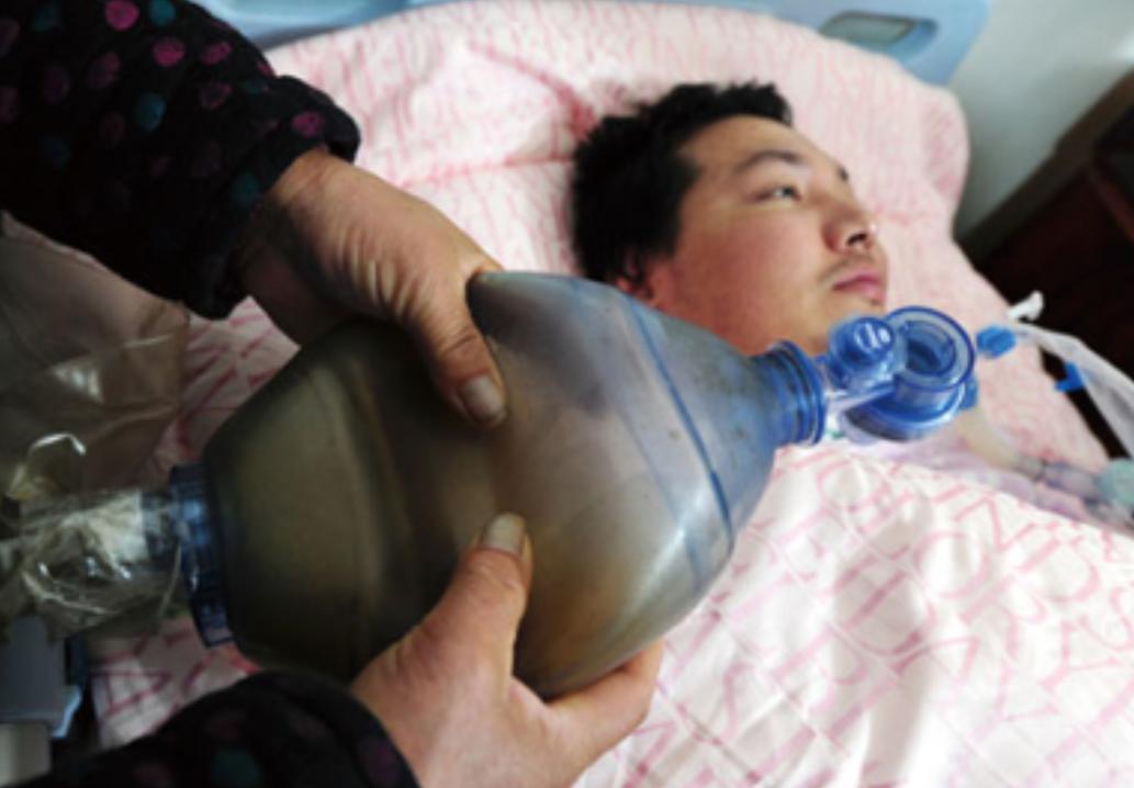 2006年，浙江一小伙因车祸永久丧失了自主呼吸功能，父母多年来捏皮球5000万次