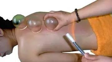 拔罐养阳气、排淤毒拔罐, 还不快去试一试!