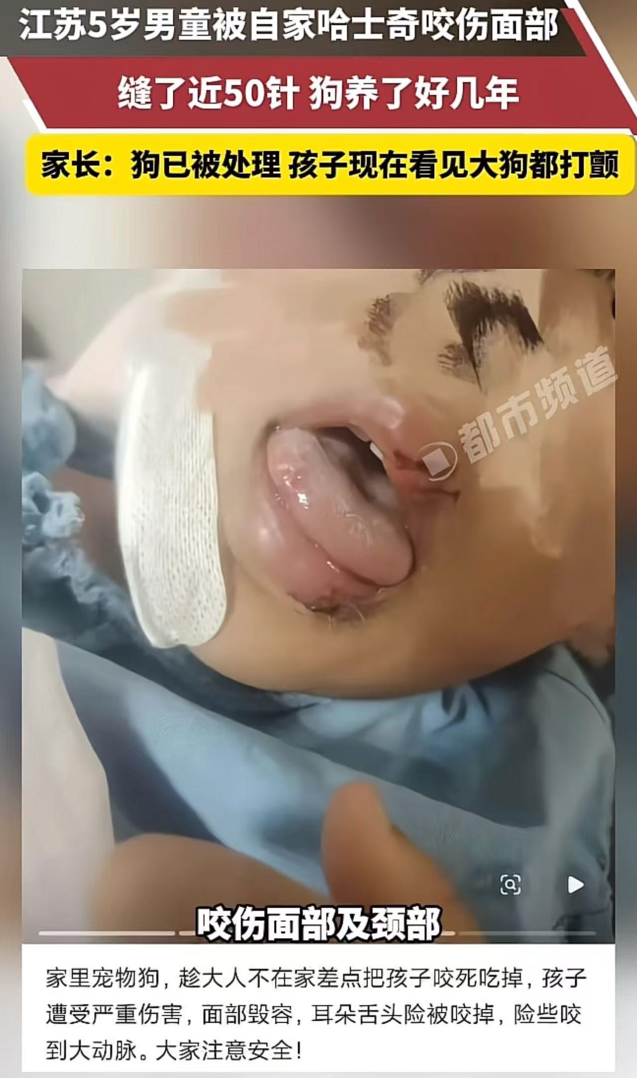 “这下养狗的都被干沉默了！”江苏，5岁男童被自家哈士奇咬伤面部，缝了近50针！孩