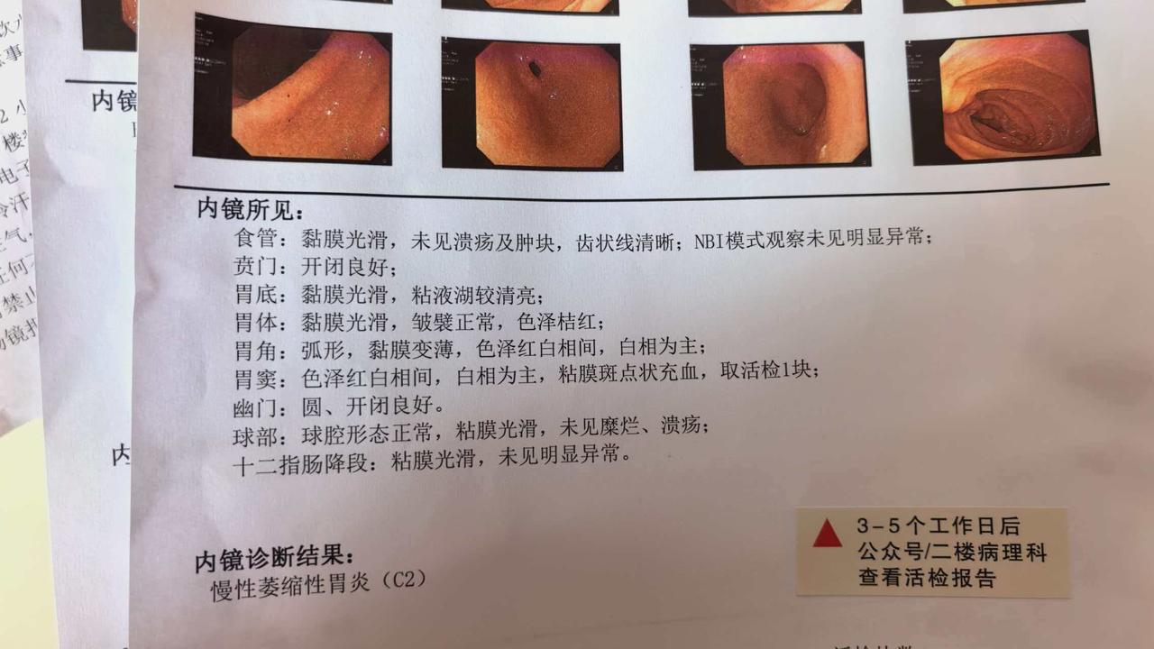 恐惧了二十几年的胃镜和肠镜检查，还是没躲过。今天去医院检查了胃肠镜，结果不太好