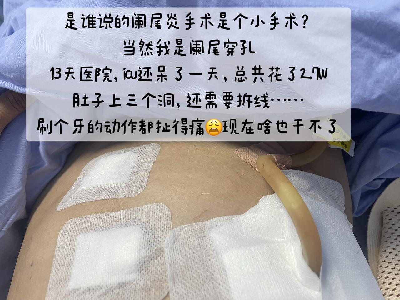 术后记录腹腔镜手术经历阑尾炎手术腹部手术后腹腔镜手术恢复