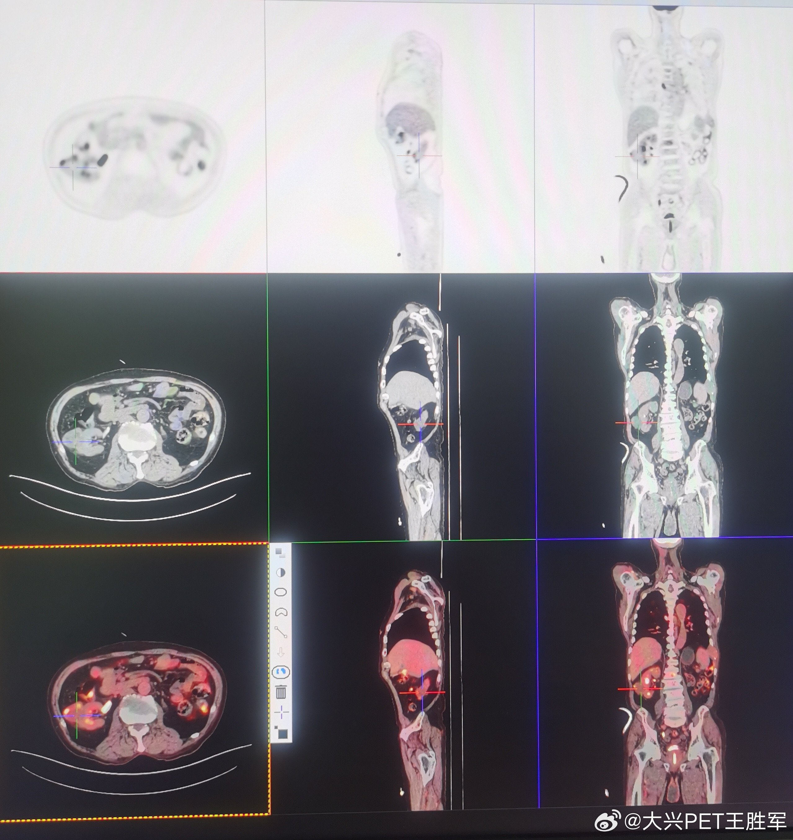 PET/CT比常规CT和核磁共振的优势在于全身无间断连续显像，发现肿瘤更全面，有