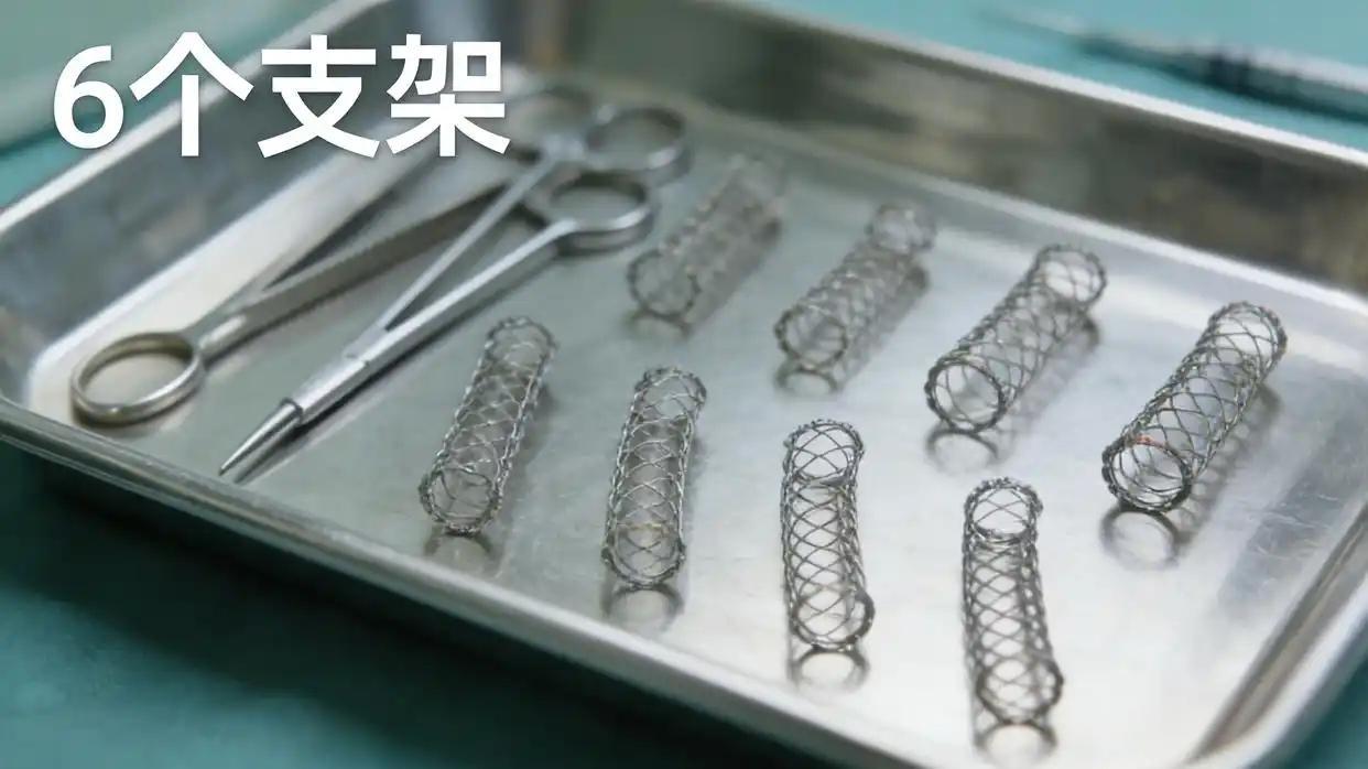 42岁男子被7通电话劝上手术台，一次植入6个支架后31分钟心脏骤停去世！听其