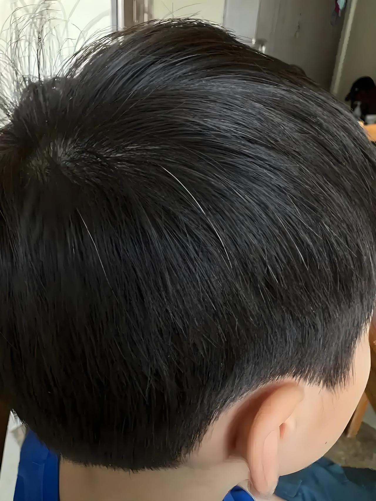 为何不要随意拔白头发？不能随意拔白头发，主要是因为这一行为可能对毛囊和头皮造成