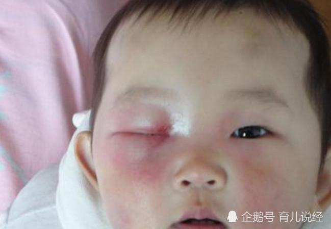 很多宝宝刚出生头上会长出小包, 很多新手父母都不知道是怎么回事