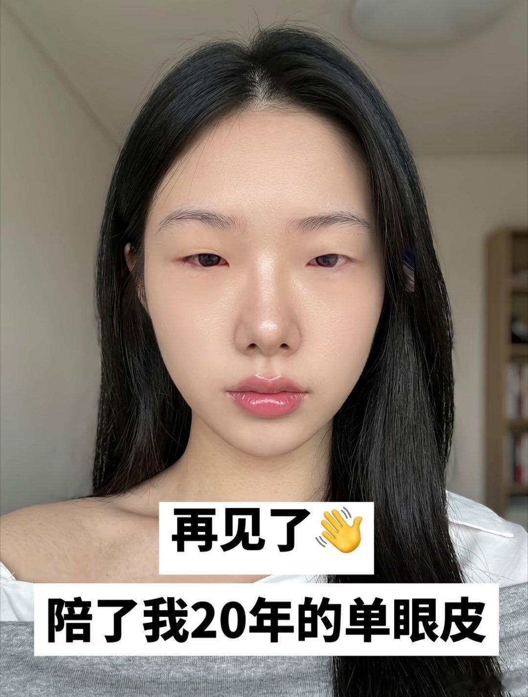 这双眼皮开得漂亮～～值了。